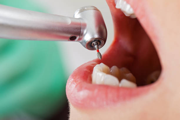 Best Emergency Wisdom Tooth Extraction in Destin, FL